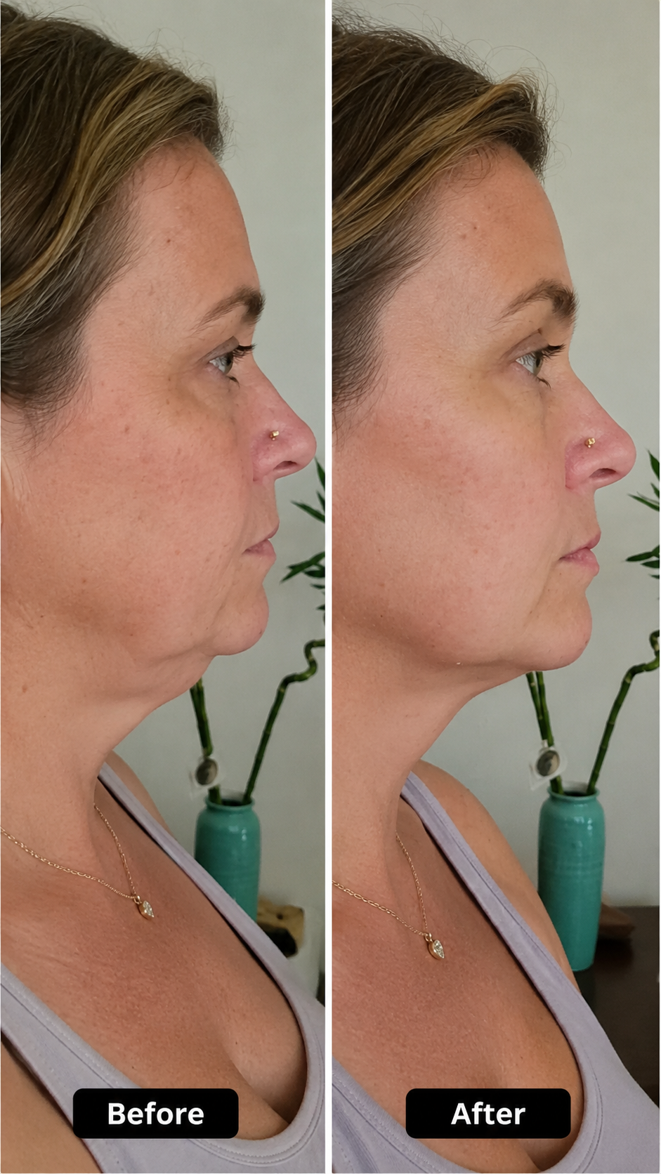 v line lifting mask