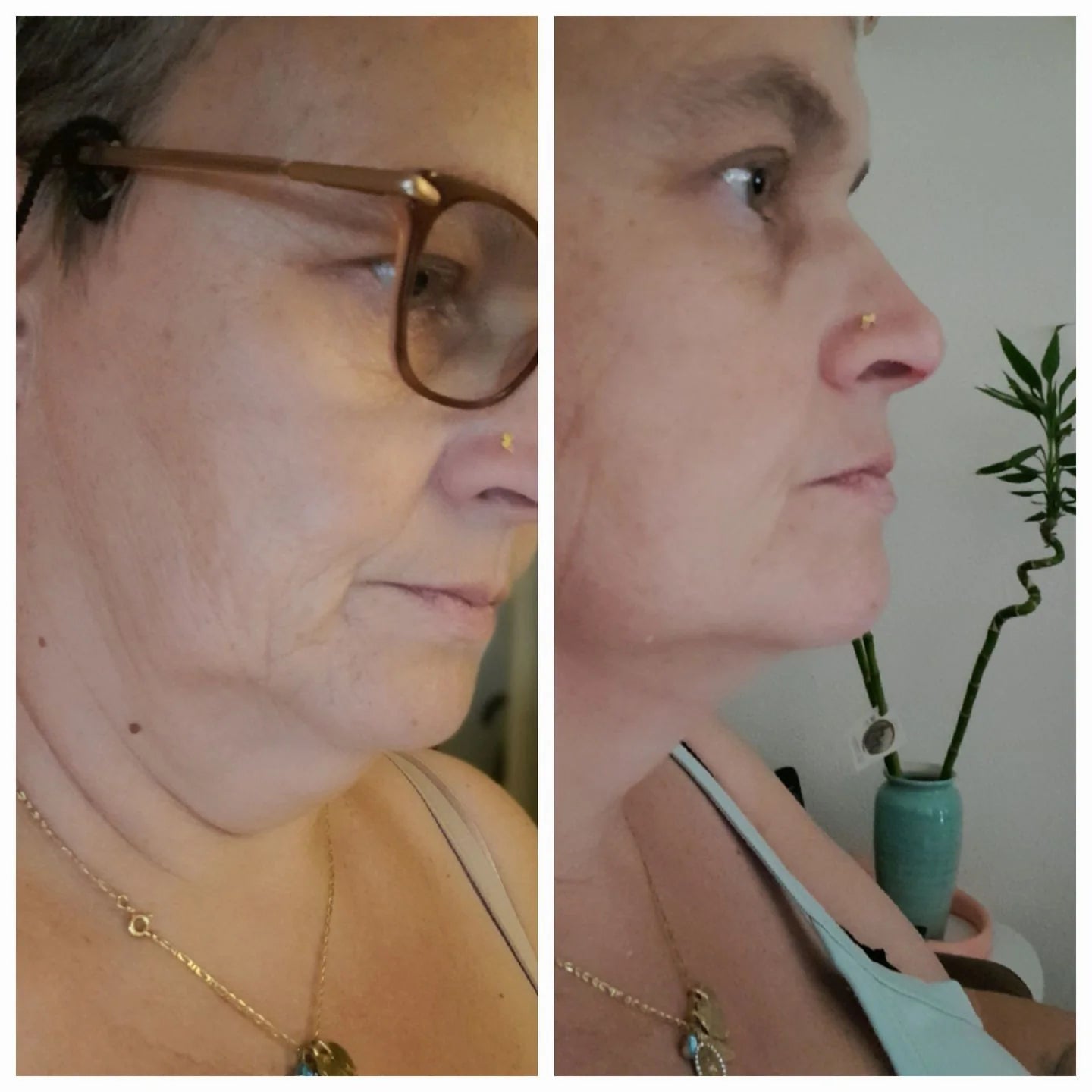 v line lifting mask